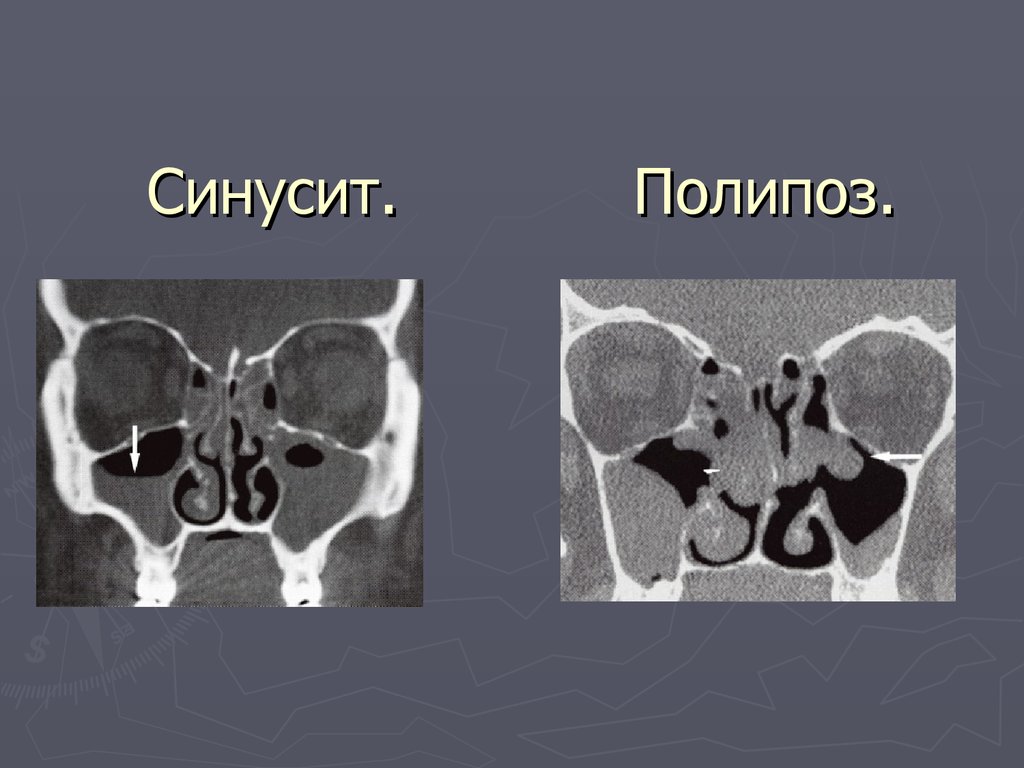 Картина кт при гайморите