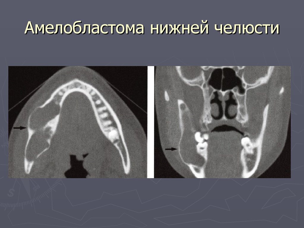 Клиническая картина амелобластомы