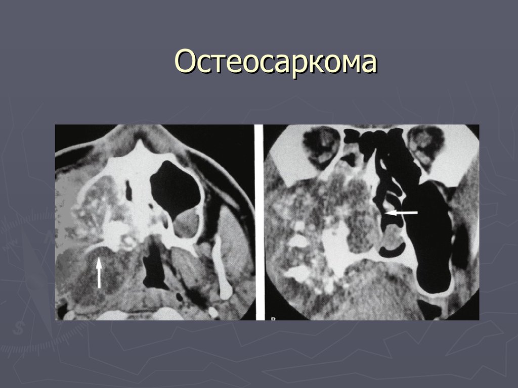 Саркома кт. Остеогенная саркома кт. Саркома нижней челюсти кт. Остеосаркома верхней челюсти кт.