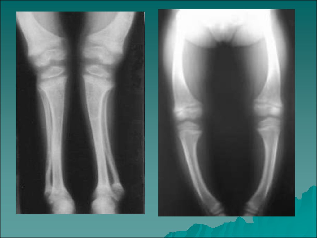Деформация костей. Рахит костные деформации. Рахит искривление костей.