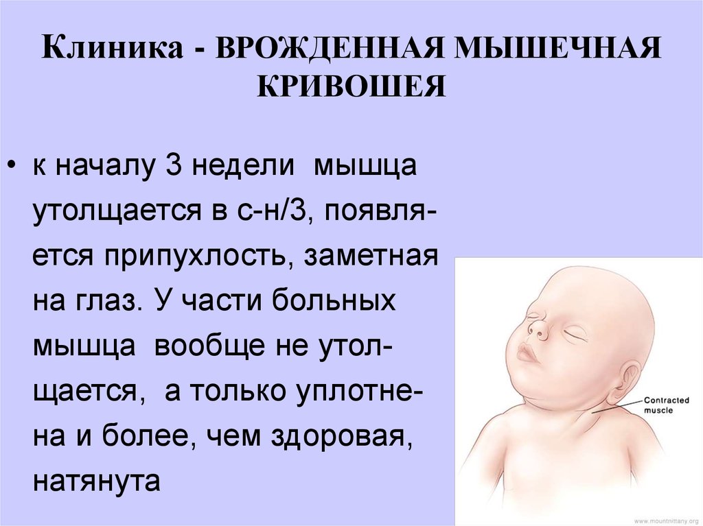 Последствия кривошеи