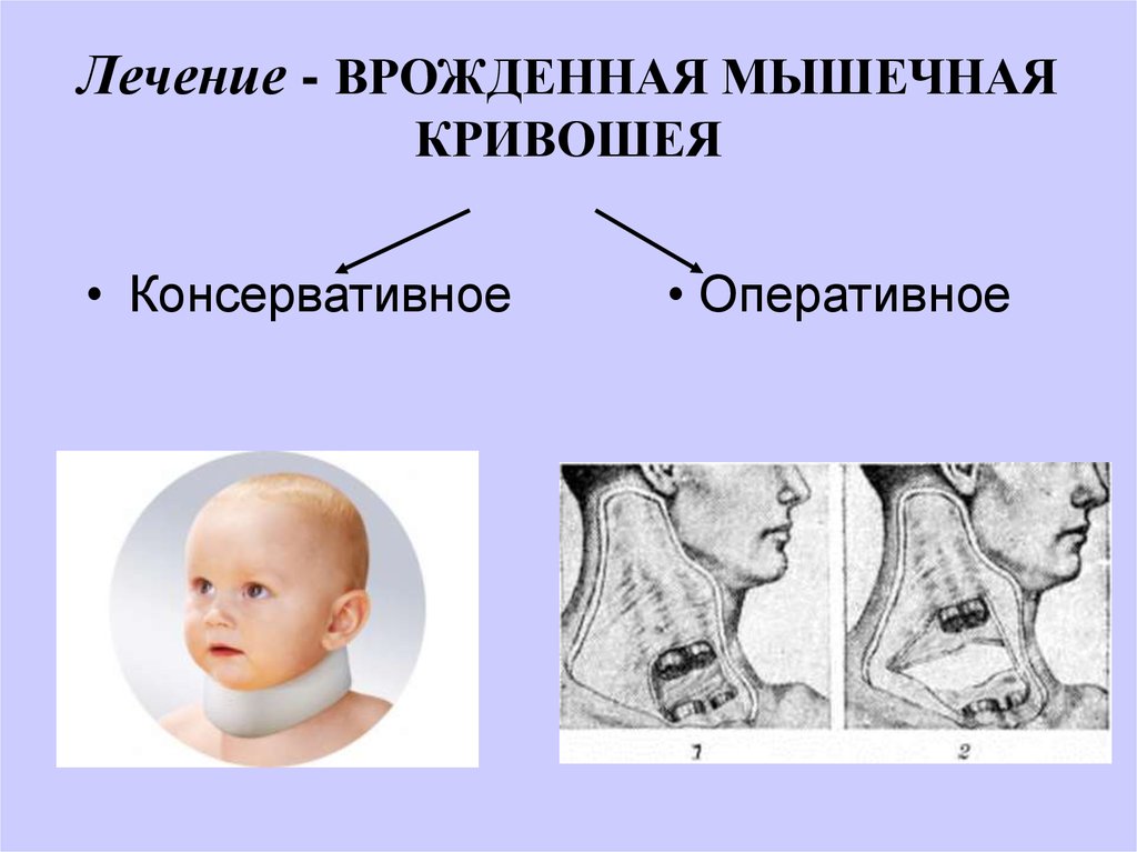 Врожденной мышечной кривошеи