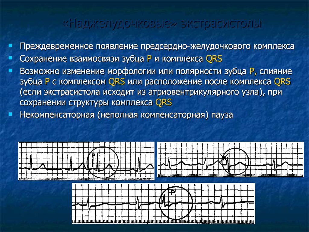 «Наджелудочковые» экстрасистолы