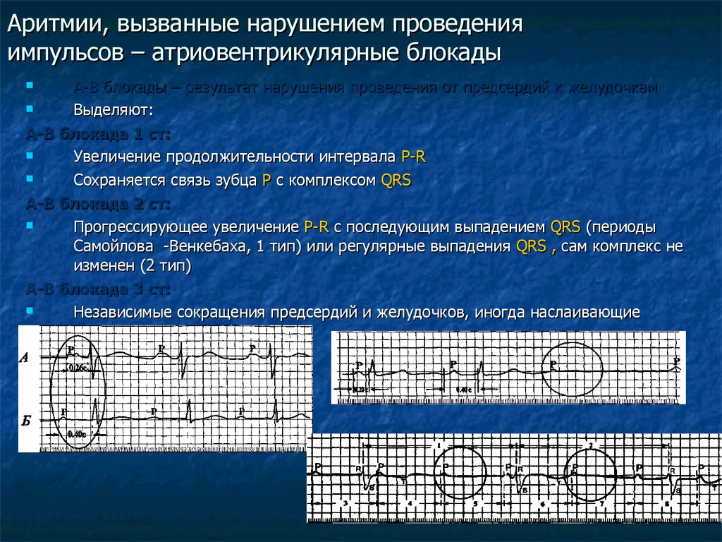 Аритмии, вызванные нарушением проведения импульсов – атриовентрикулярные блокады