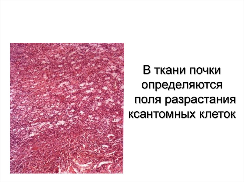 Ткани почки. Ксантомные клетки патанатомия. Разрастание соединительной ткани. Опишите строение ксантомных клеток. Ксантомные клетки на микропрепарате.