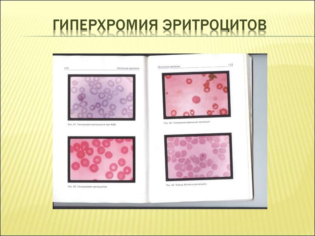 Гипохромия железодефицитная анемия. Гиперхромия эритроцитов. Гипохромия и гиперхромия. Гиперхромия клеток. Эритроциты мазок гиперхромия.