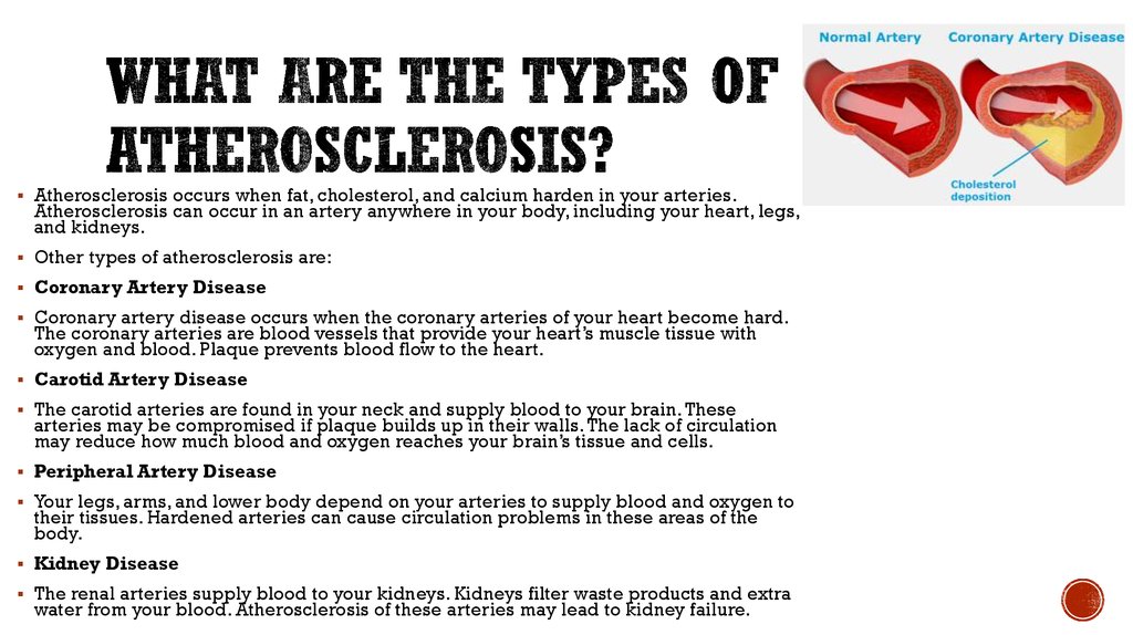 Atherosclerosis латынь. A Heart condition in which fatty materials accumulate in arteries and Harden their Walls.