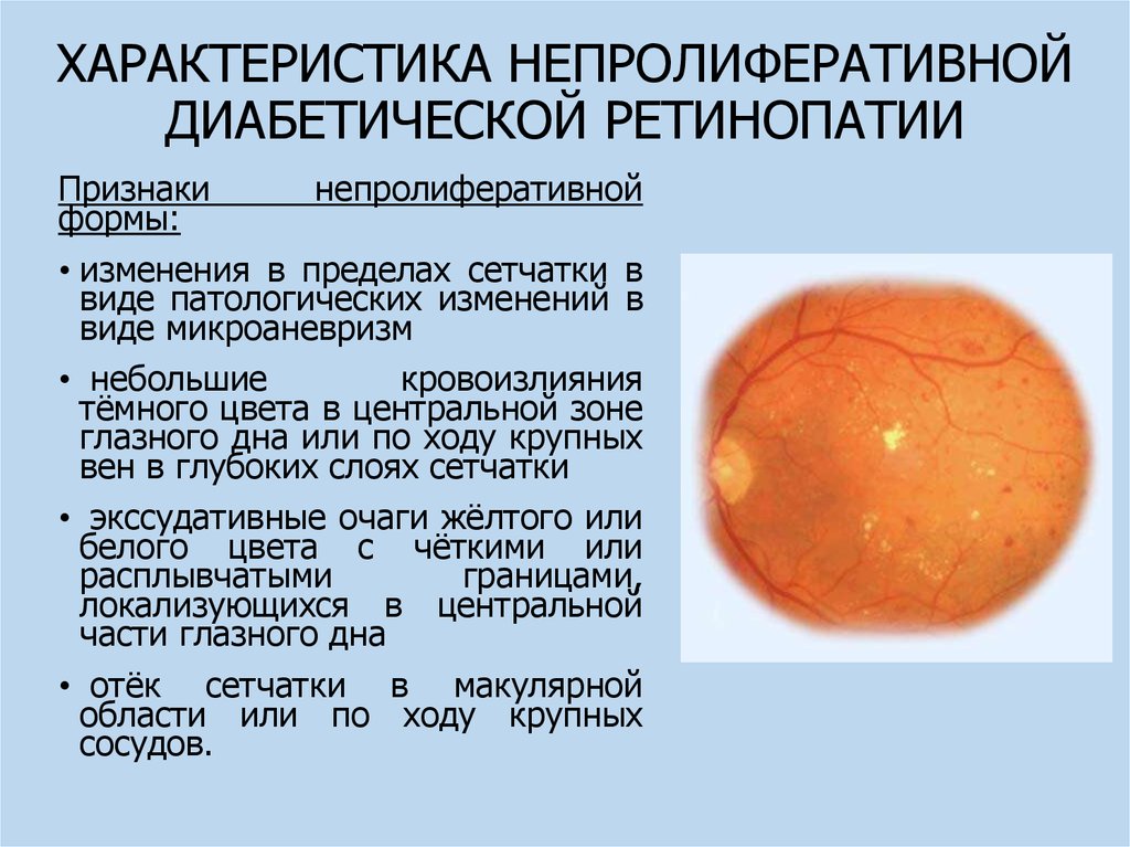 Диабетическая ретинопатия презентация офтальмология