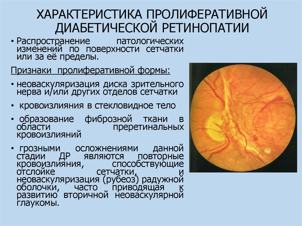 Диабеттік ретинопатия презентация