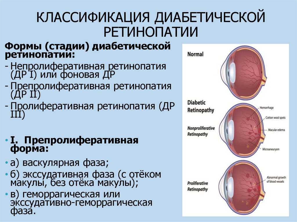 Ангиопатия сосудов мкб. Непролиферативная диабетическая ретинопатия классификация. Диабетическая непролиферативная ретинопатия симптомы. Диабетическая ретинопатия стадии. Стадии диабетической ретинопатии.