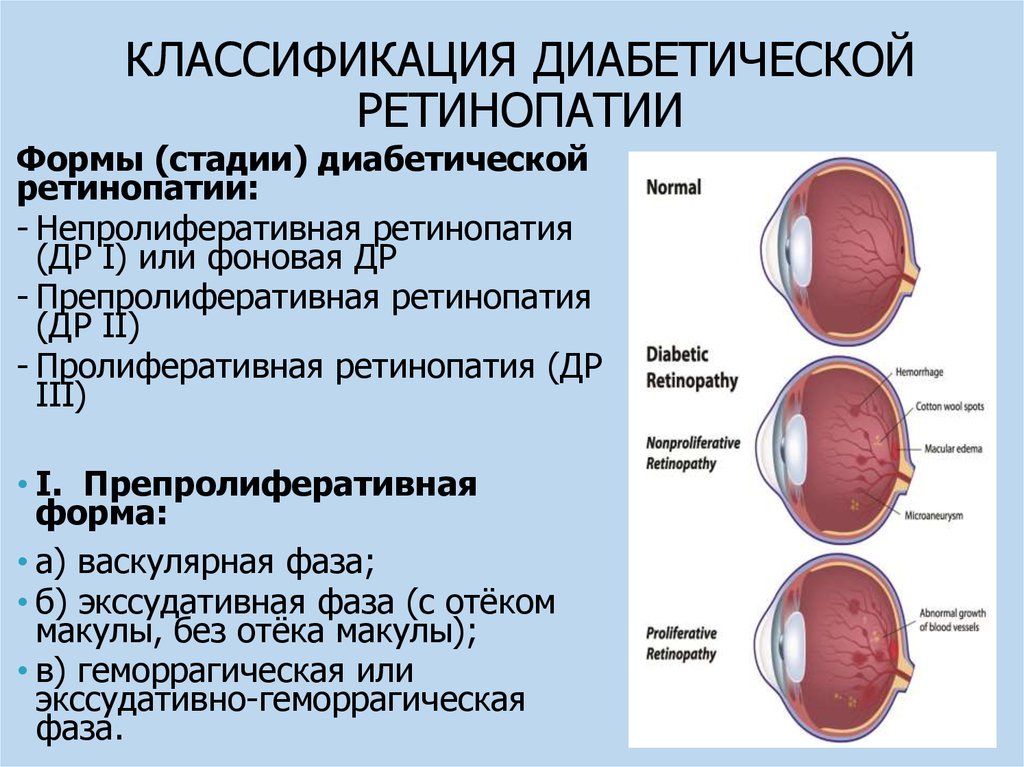 Диабетическая ретинопатия