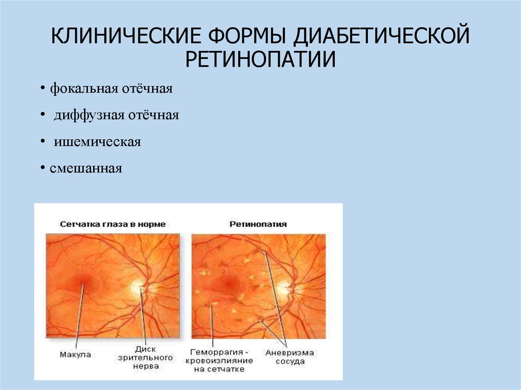 Диабеттік ретинопатия презентация