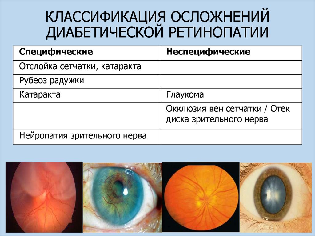 Классификация глаукомы. Диабетическая ретинопатия сетчатки. Диабетическая ретинопатия осложнения. Диабетическая ретинопатия глаз. Пролиферативная диабетическая ретинопатия классификация.