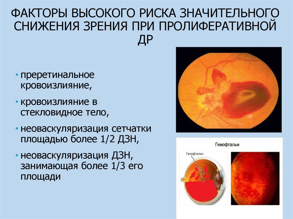 Кровоизлияние в стекловидное. Субретинальное кровоизлияние. Субретинальное кровоизлияние окт. Преретиеалтное кровоизл. Преретинальные и ретинальные кровоизлияния.