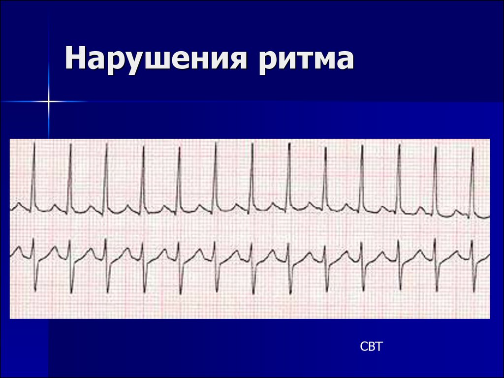 Нарушение ритма. Суправентрикулярный ритм на ЭКГ. Суправентрикулярные нарушения ритма. Наджелудочковый ритм.