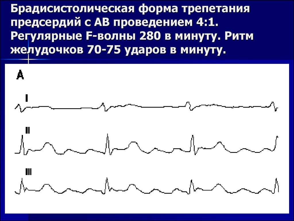 Карта вызова фибрилляция