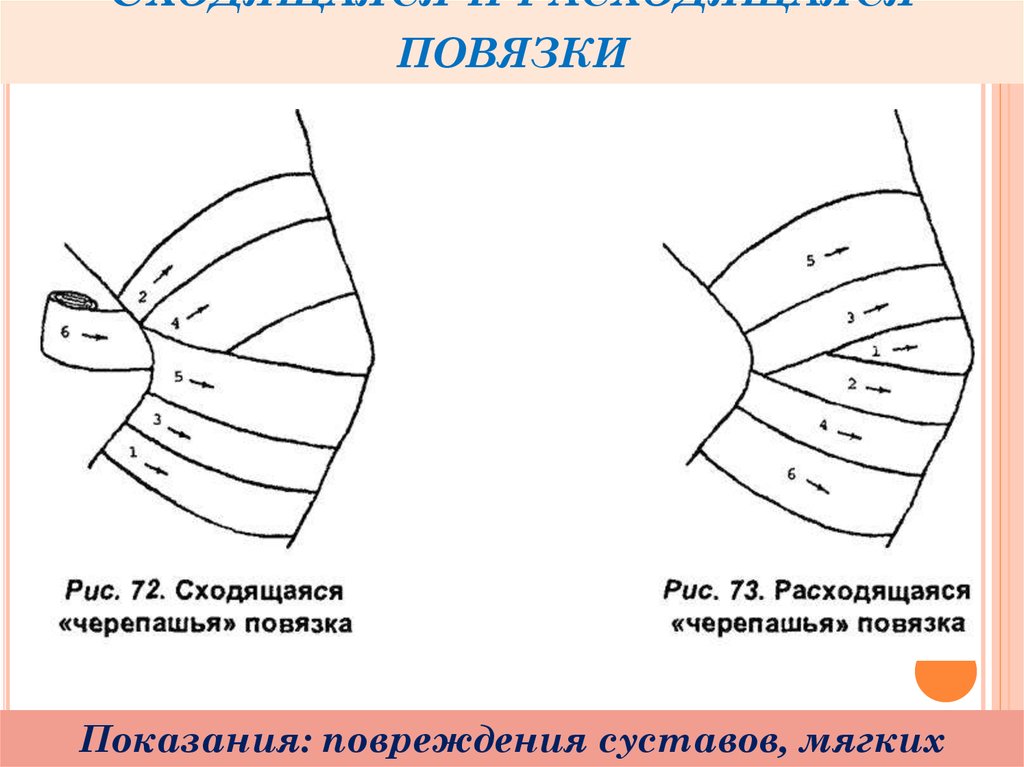 Наложение повязки на коленный сустав. Сходящаяся черепашья повязка. Расходящаяся черепашья повязка на локтевой сустав алгоритм. Схема наложения черепашьей повязки на коленный сустав. Повязка черепашья сходящаяся показания.