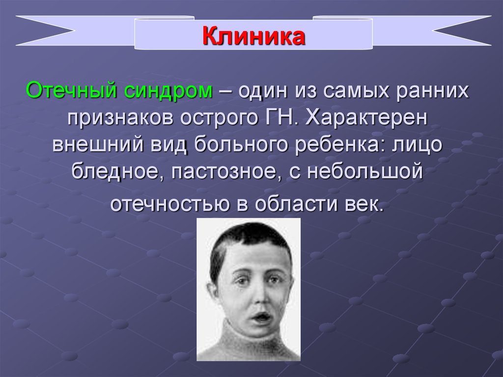 Отечный синдром. Отечный синдром обусловлен. Отечный синдром проявления. Отечный синдром клиника. Что характерно для отечного синдрома.