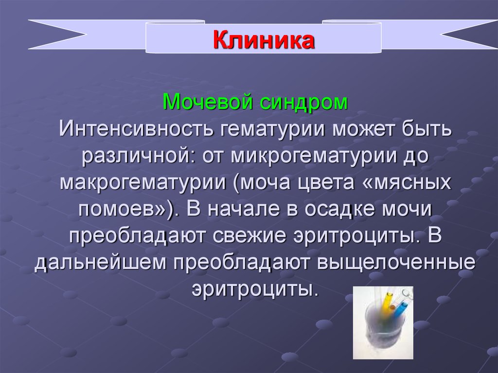 Моча мясных помоев. Моча мясных помоев обусловлена. Моча цвета мясных помоев синдром. Моча цвета мясных помоев наблюдаются при. Моча приобретает цвет 