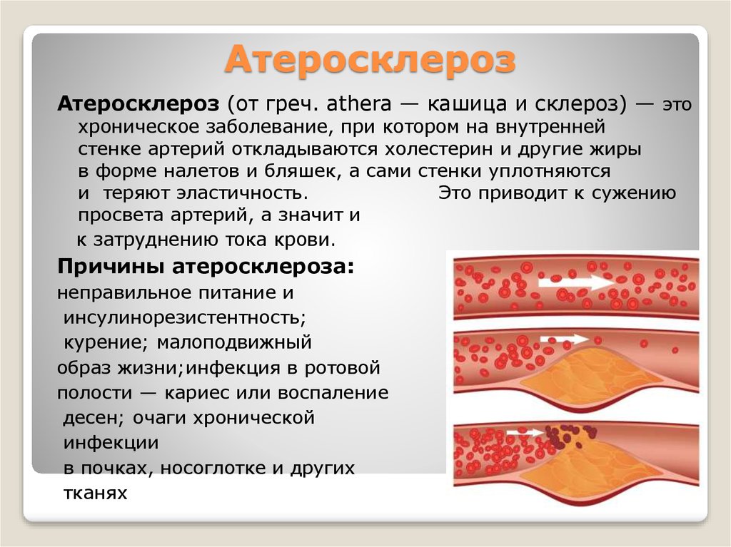 Картинки атеросклероз сосудов