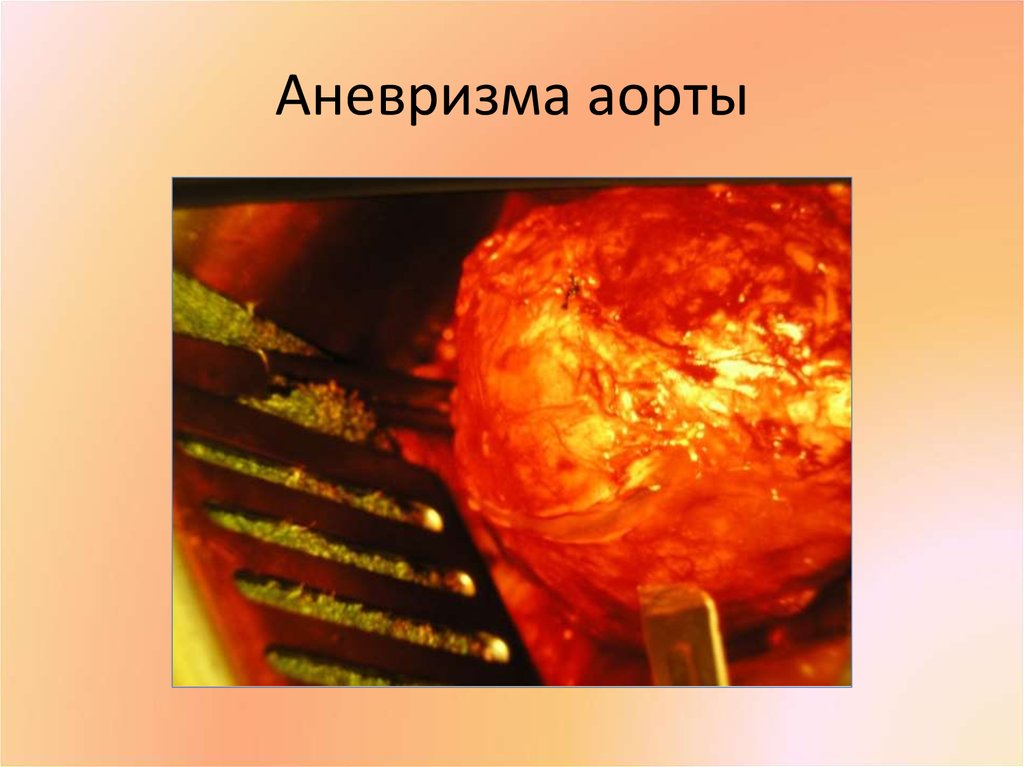 Аневризма аорты