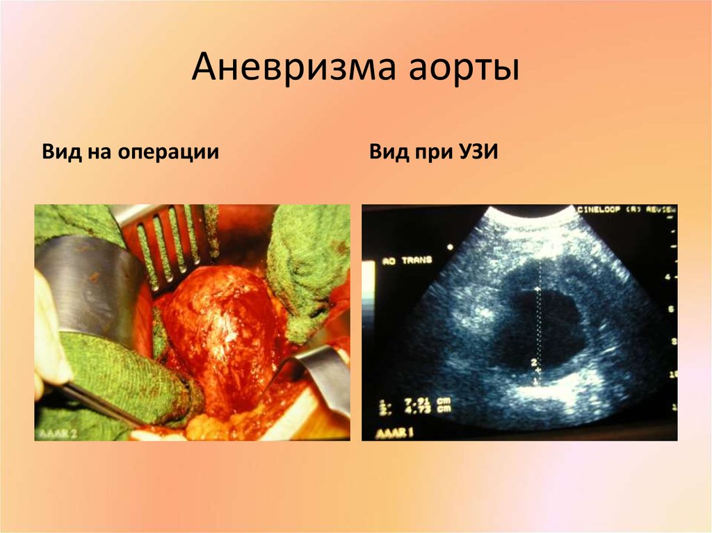 Аневризма аорты