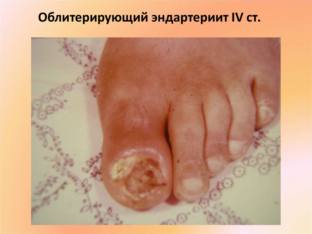 Облитерирующий эндартериит IV ст.