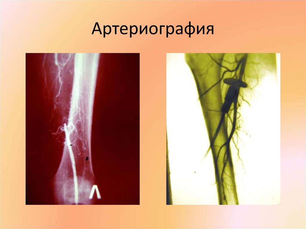 Артериография
