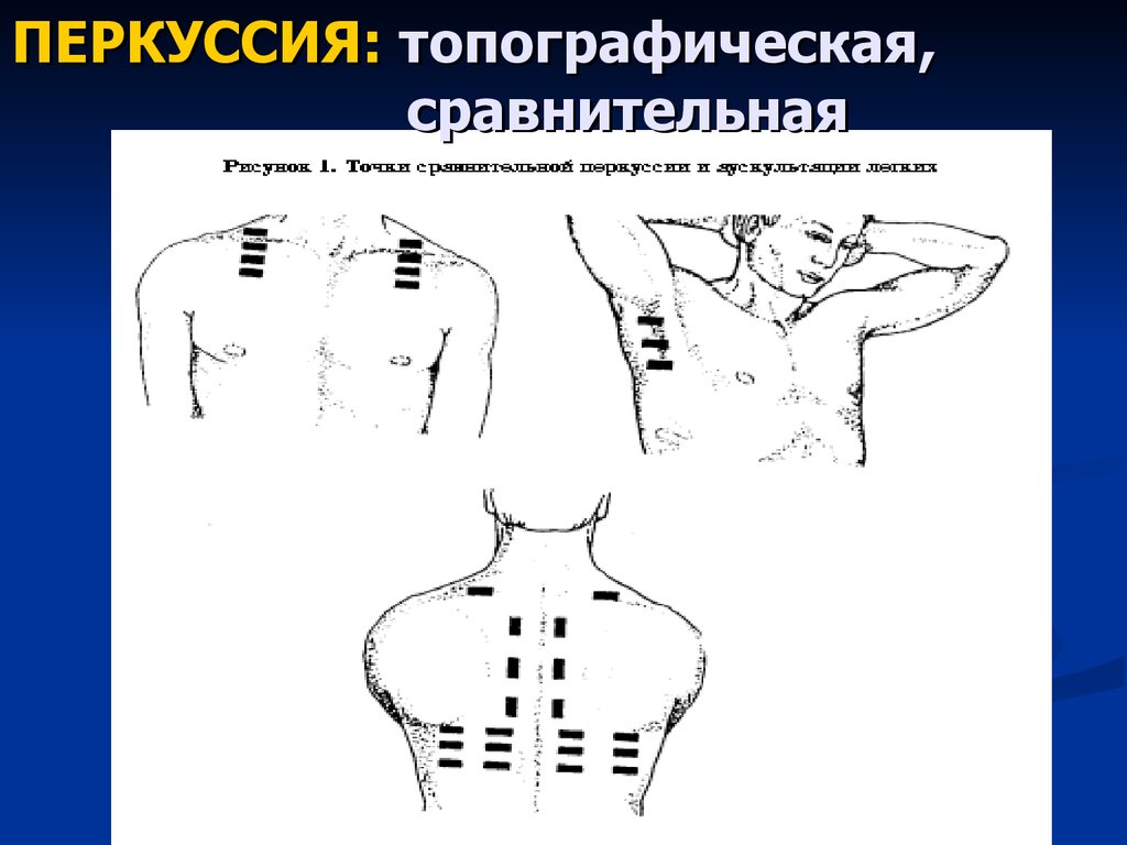 Перкуссия легких схема