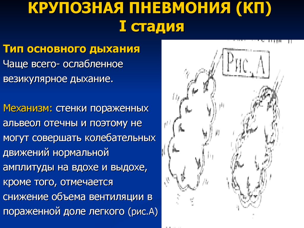 Степени пневмонии