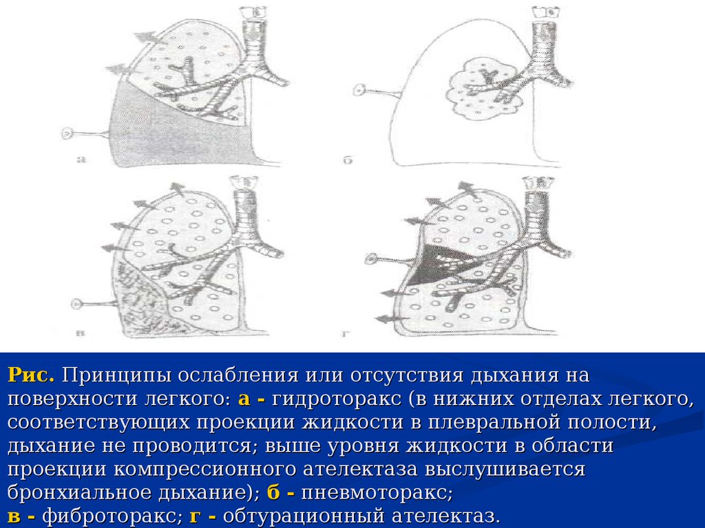 Объем гидроторакса. УЗИ плевральных синусов. Гидроторакс УЗИ плевральных полостей. УЗИ плевральных полостей пневмоторакс. Подготовка пациента к УЗИ плевральной полости.