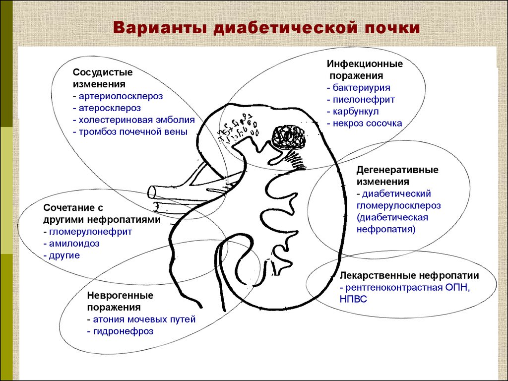 Почки при диабете. Гломерулосклероз диабетическая нефропатия. Диабетическая нефропатия схемы. Механизм развития диабетической нефропатии. Диабетическая нефропатия с макропротеинурией.