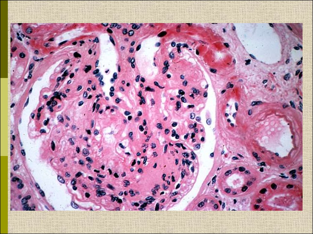 Почки при диабете. Диабетическая нефропатия патанатомия. Диабетическая нефропатия гистология. Гломерулонефрит гистология. Диабетический гломерулосклероз патанатомия.