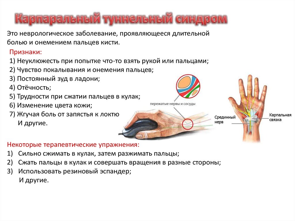 Запястный синдром. Карпальный туннельный синдром запястья симптомы. Признак запястья и большого пальца. Механизм сжатия пальцев руки.