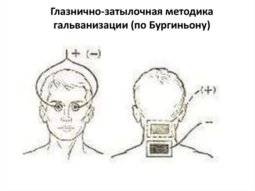 Проведение процедуры гальванизации