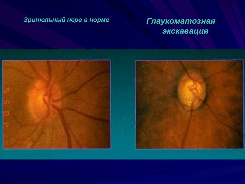Норма зрительного нерва. Экскавация диска зрительного нерва. Глаукоматозная экскавация зрительного нерва. Экскавация зрительного нерва норма. Экскавация диска зрительного нерва норма.