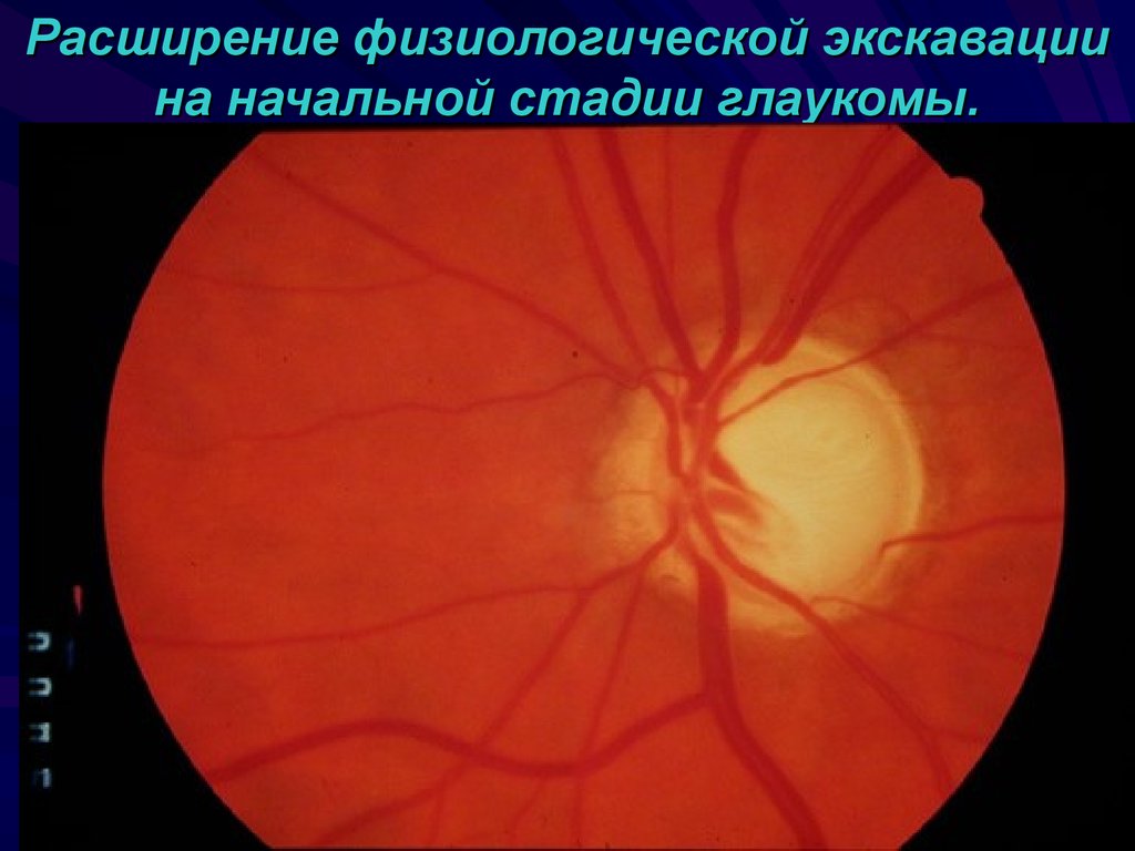 Норма зрительного нерва. Глаукоматозная экскавация зрительного нерва. Глаукомная экскавация ДЗН. Экскавация глазного дна.