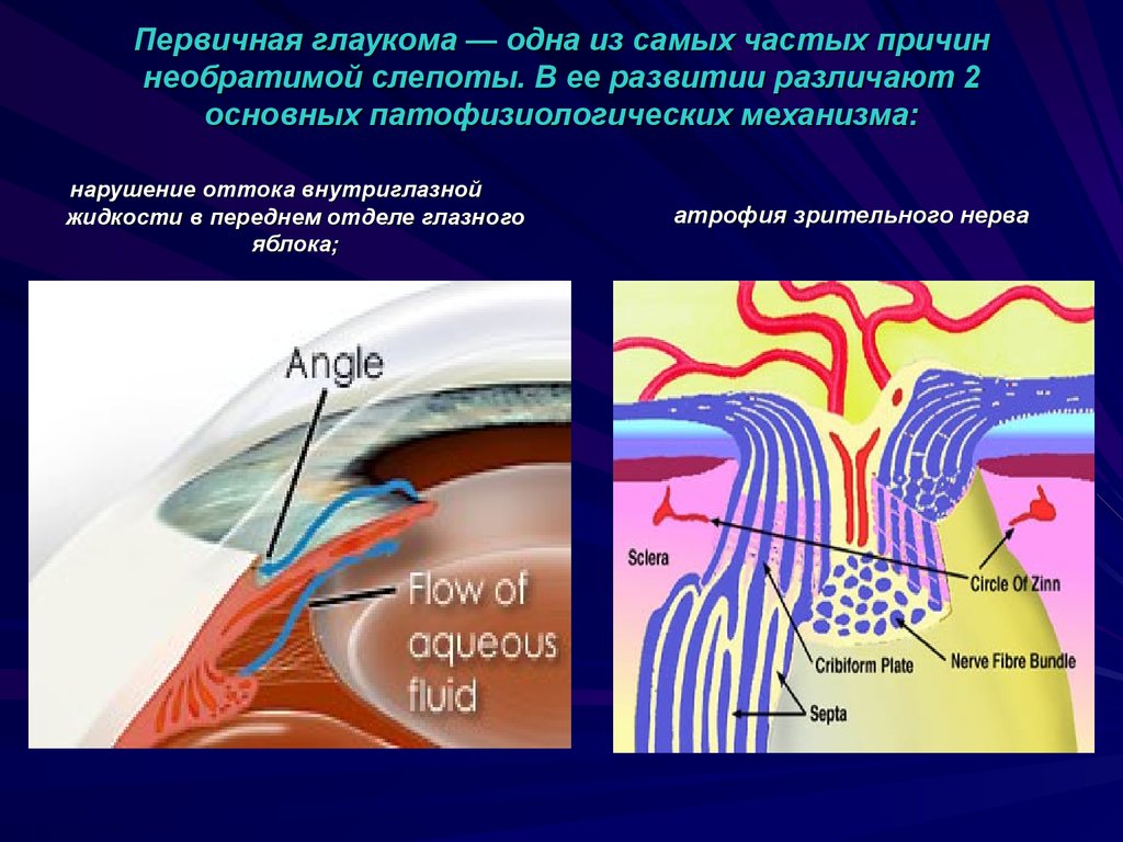 Классификация глаукомы. Открытоугольная глаукома этиология. Патогенез первичной глаукомы. Причины первичной глаукомы. Патогенез открытоугольной глаукомы.