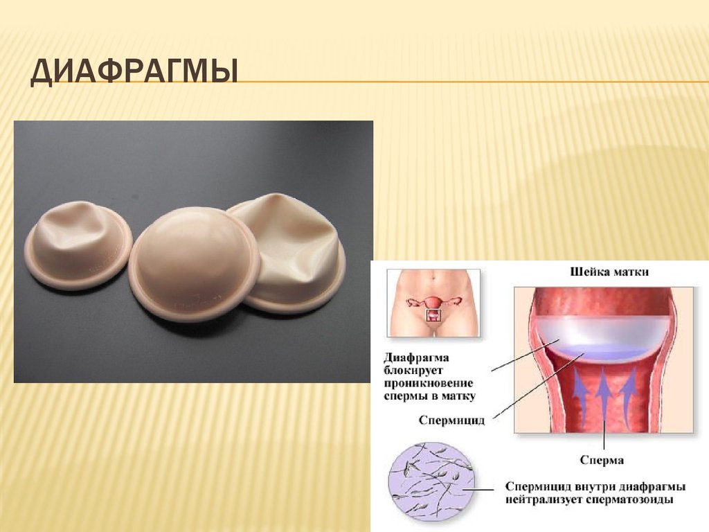Барьерный съязвить. Влагалищные диафрагмы контрацептивы. Диафрагма (контрацепция). Шеечный колпачок. Методы контрацепции диафрагма.