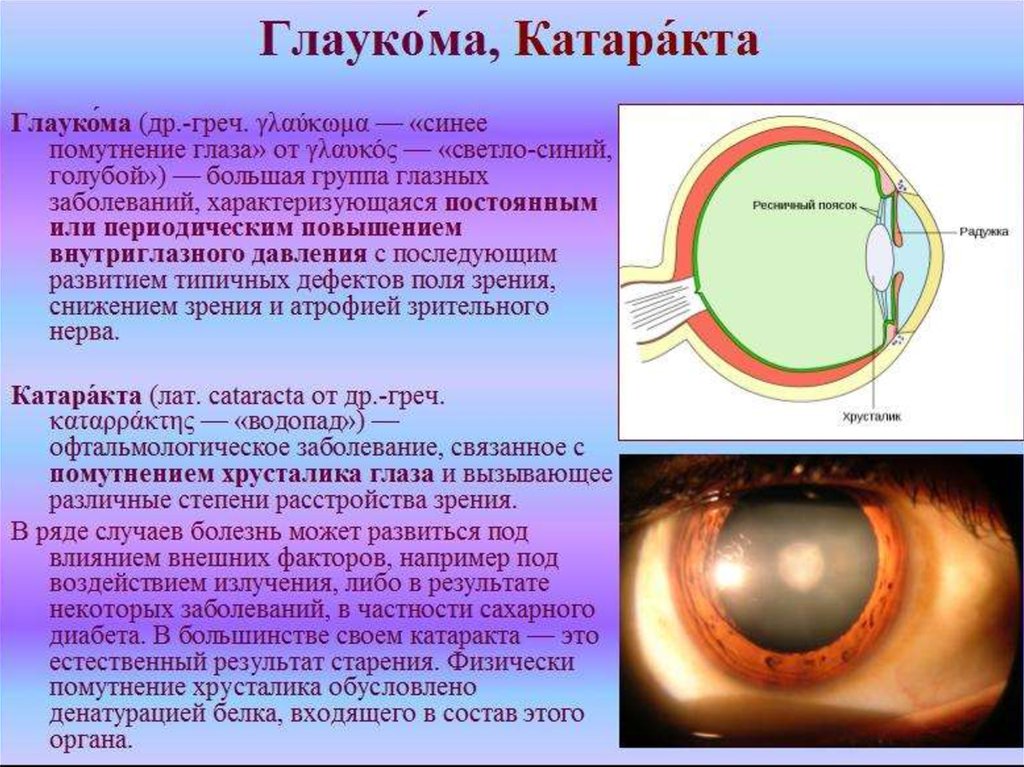 Практическая работа принцип работы хрусталика биология. Глаукома и катаракта отличия. Глаукома и катаракта глаза симптомы. Глаза катаракта глаукома.