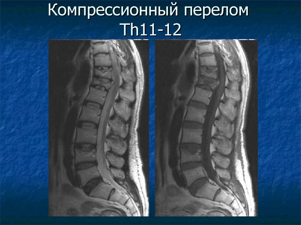 Лечение последствия компрессионного перелома позвоночника. Компрессионный перелом позвоночника th-5-6. Компрессионный перелом позвоночника th11. Компрессионный перелом l1 th12. Компрессионный перелом позвоночника th12 l2.