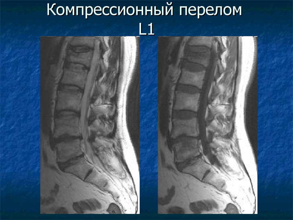 Травма поясничного отдела позвоночника. Компрессионный перелом позвоночника l1. Компрессионный перелом позвоночника l5. Компрессионный перелом остеопороз. Компрессионный перелом позвоночника l1 поясничного отдела.