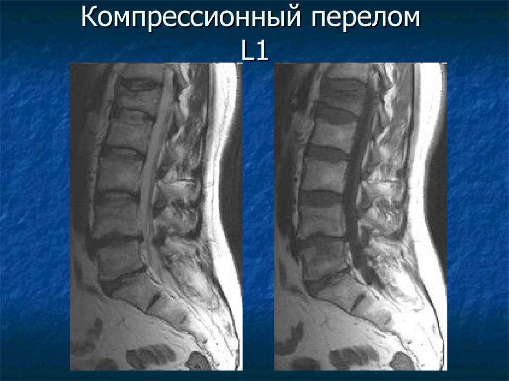 Компрессионный перелом отдела позвоночника. Неосложненный компрессионный перелом позвоночника. Компрессионный перелом l1 позвонка. Компрессионный перелом л3 л4. Закрытый компрессионный перелом тела l1 позвонка.