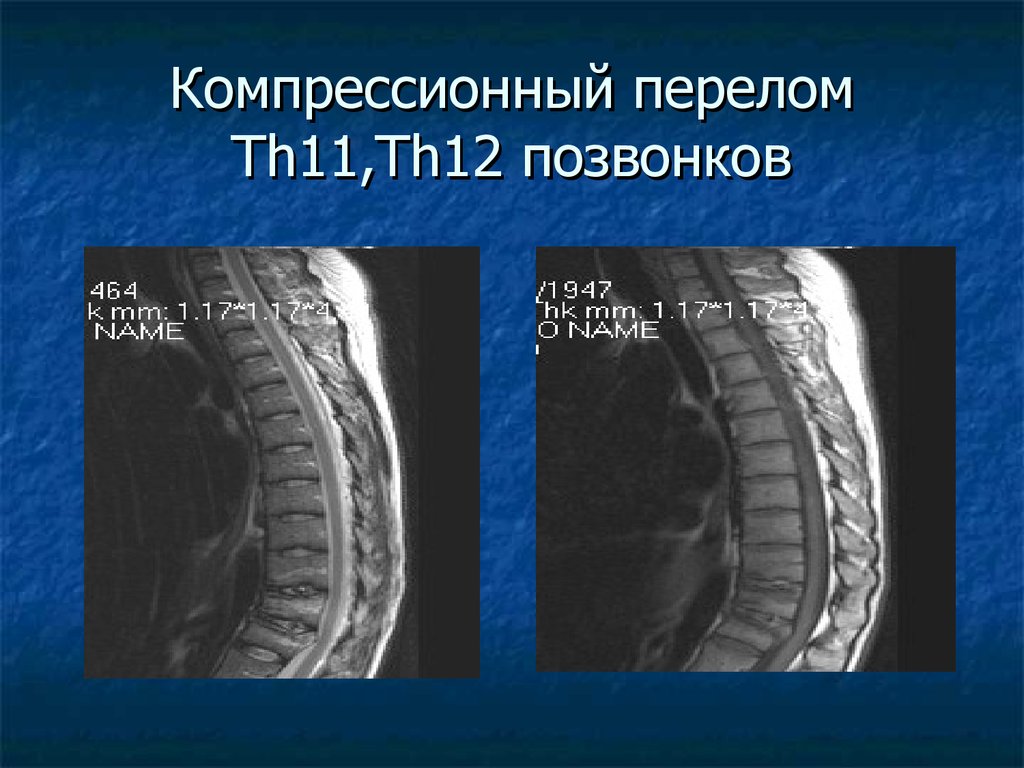 Лечение последствия компрессионного перелома позвоночника. Компрессионный перелом l1 th12. Компрессионный перелом l1 позвонка. Компрессионный перелом l1 l2 позвонков. Компрессионный перелом тела 12 грудного позвонка спинного мозга.