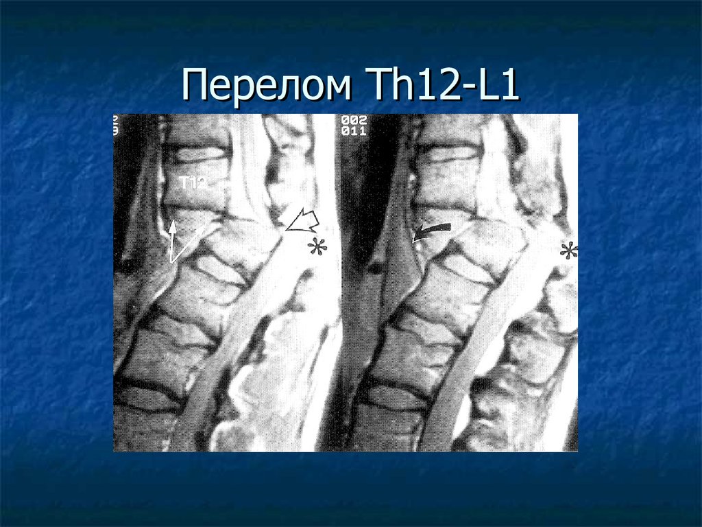 Компрессионный перелом тела 1 1. Компрессионный перелом l1 th12. Компрессионный перелом l1 позвонка. Компрессионный перелом позвоночника th12 l3. Компрессионный перелом th12 позвонка.