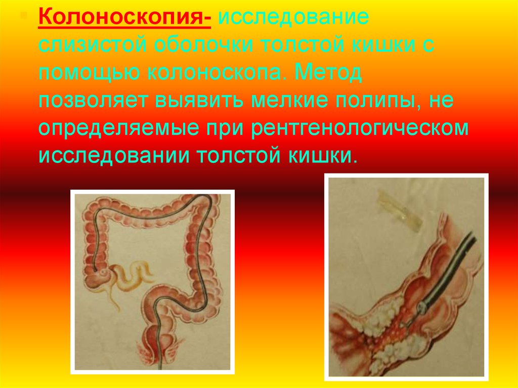 Исследование толстой. Методы исследования Толстого кишечника. Исследование толстой кишки колоноскопия. Инструментальные методы исследования толстой кишки. Метод исследования Толстого кишечника.