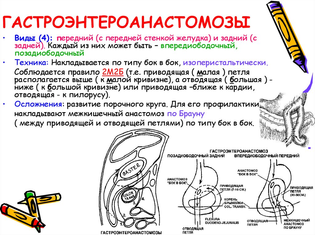 Анастомоз по ру схема