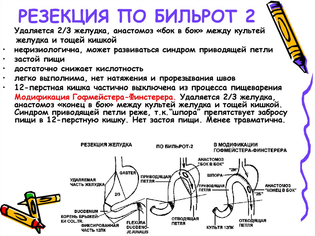 2 3 желудка. Операция по Бильрот 2 в модификации гофмейстера-Финстерера.