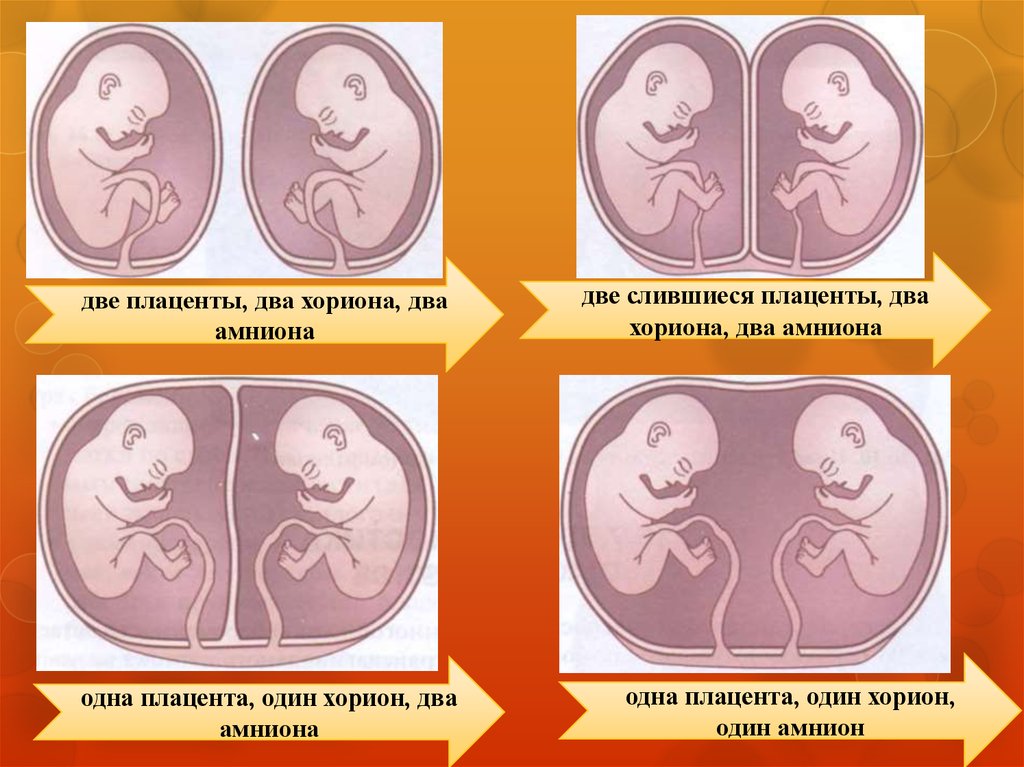Бывает ли двойной. Монохориальная моноамниотическая многоплодная беременность. Многоплодная беременность типы плацентации. Многоплодная беременность амнион. Типы плацентации при многоплодной беременности.