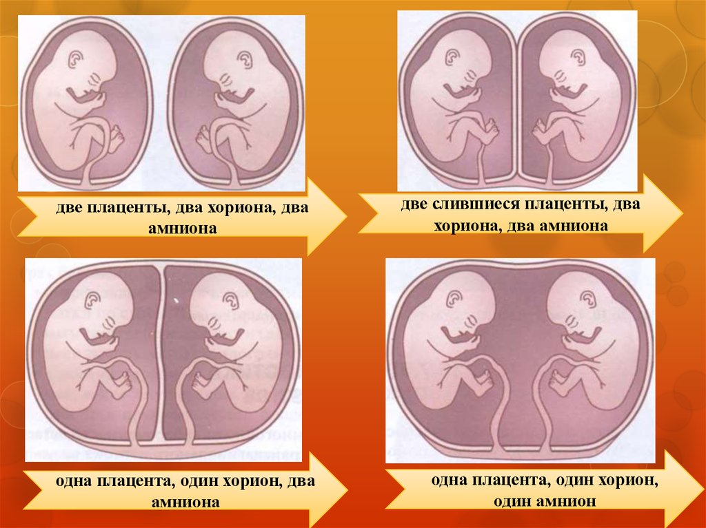 Двойной плод. Плацентация многоплодная беременность. Монохориальная моноамниотическая плацента близнецов. Многоплодная беременность амнион и хорион. Монохориальная многоплодная беременность.